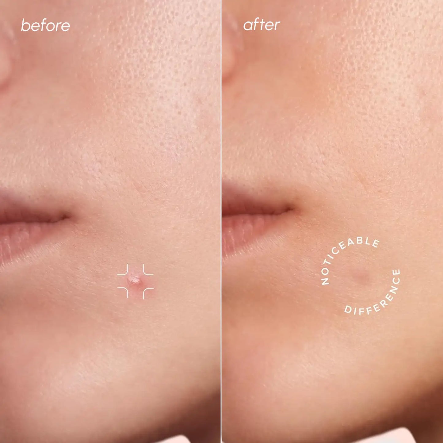 Invisible Pimple & Acne Patches - Hide & Heal