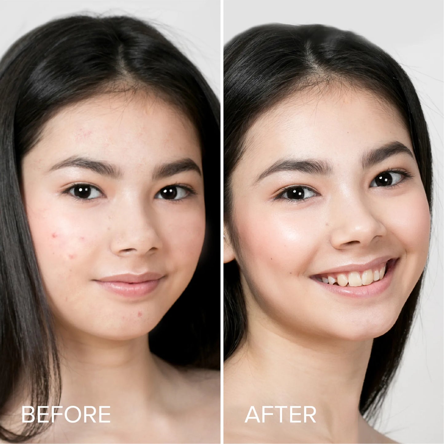 Pimple & Acne Patches - Cute, Clear & Fast-Acting